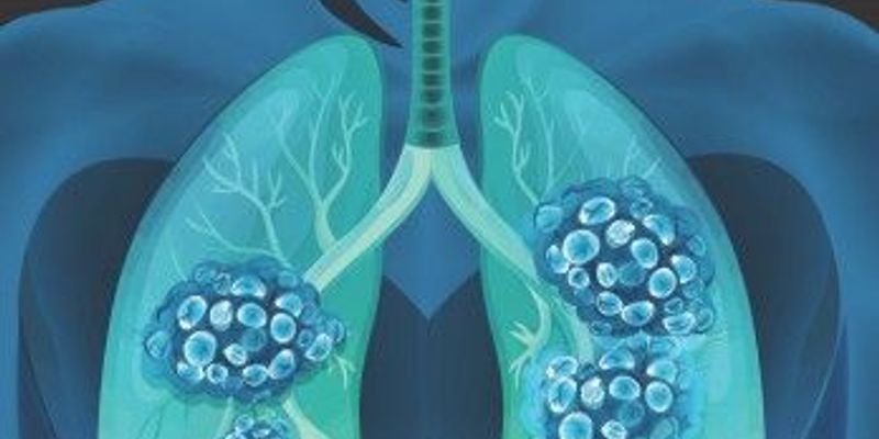 广泛期小细胞肺癌新希望：度伐利尤单抗联合方案显著改善生存期，耐受性良好