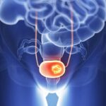 Detalimogene治疗BCG无应答非肌层浸润性膀胱癌：6个月完全缓解率达62%