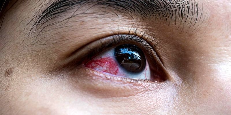 干燥综合征早期诊断：如何识别症状并预防淋巴瘤风险？