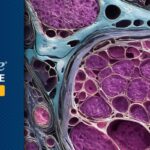 软组织肉瘤新突破：Mecbotamab Vedotin将中位总生存期延长至21.5个月！