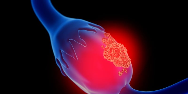 奥拉帕利联合免疫疗法治疗卵巢癌：SOLACE2研究揭示PFS改善趋势