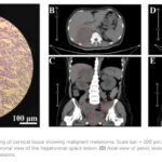 HER2扩增宫颈黏膜黑色素瘤治疗突破：德曲妥珠单抗联合方案疗效显著
