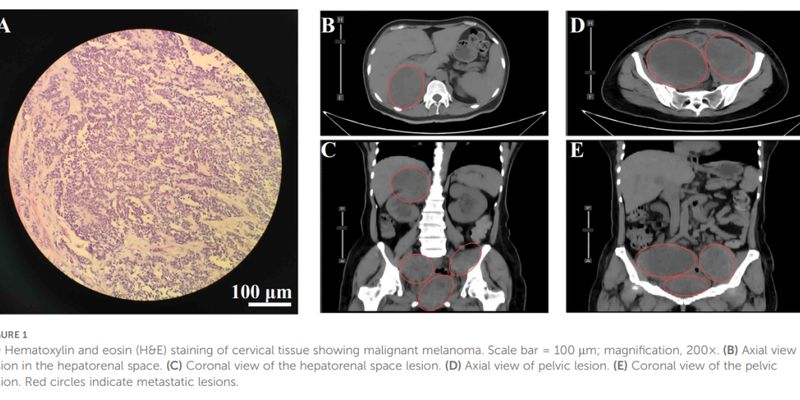 HER2扩增宫颈黏膜黑色素瘤治疗突破：德曲妥珠单抗联合方案疗效显著