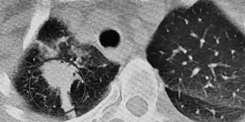 肺癌筛查范围扩大：是拯救更多生命的福音，还是过度诊断的开端？