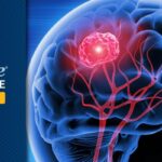 替莫唑胺联合放疗显著延长IDH突变低级别胶质瘤患者生存期