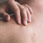 黑色素瘤新辅助治疗：纳武利尤单抗联合伊匹木单抗真实世界数据优于帕博利珠单抗