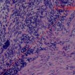 罕见子宫肿瘤UTROSCT：诊断、病理特征与治疗方案全解析