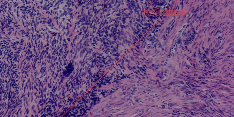 罕见子宫肿瘤UTROSCT：诊断、病理特征与治疗方案全解析