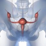 阿替利珠单抗联合尼拉帕利治疗卵巢癌：ANITA III期研究未达预期