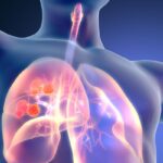 度伐利尤单抗联合铂类-依托泊苷方案：广泛期小细胞肺癌（ES-SCLC）治疗新选择及临床研究进展