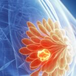 Sacituzumab Govitecan (Trodelvy)治疗HR+/HER2-转移性乳腺癌：ASCENT-07研究结果深度解读与用药考量