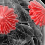 艾拉司群（Elacestrant）联合用药：ER+/HER2–乳腺癌最新治疗方案与PFS数据解析