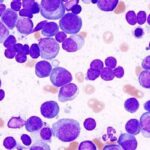 Ciltacabtagene autoleucel (Carvykti) 为复发/难治性多发性骨髓瘤患者带来长期生存新希望