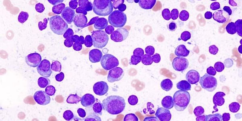 Ciltacabtagene autoleucel (Carvykti) 为复发/难治性多发性骨髓瘤患者带来长期生存新希望