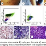 贝林妥欧单抗显奇效：NF1基因突变患儿复发B淋巴母细胞淋巴瘤治疗成功案例