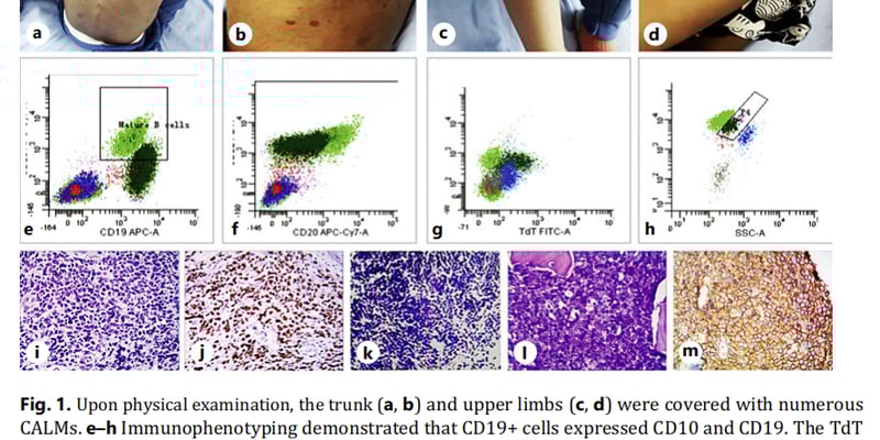 贝林妥欧单抗显奇效：NF1基因突变患儿复发B淋巴母细胞淋巴瘤治疗成功案例