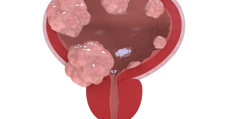 顺铂适用MIBC患者新选择：Enfortumab Vedotin联合K药，生存期数据与海外购买渠道解析