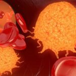 奥雷巴替尼一线治疗Ph+急性淋巴细胞白血病：全球关键3期临床试验获FDA与EMA批准