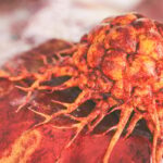 新型影像剂 RAD 101：如何精准鉴别脑转移瘤复发与放射性坏死？最新临床研究解读