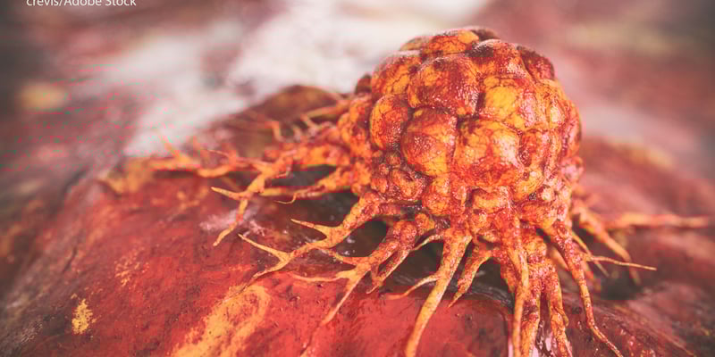 新型影像剂 RAD 101：如何精准鉴别脑转移瘤复发与放射性坏死？最新临床研究解读