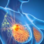 BRCA突变携带者使用激素替代疗法（HRT）安全吗？最新研究打破乳腺癌复发禁忌