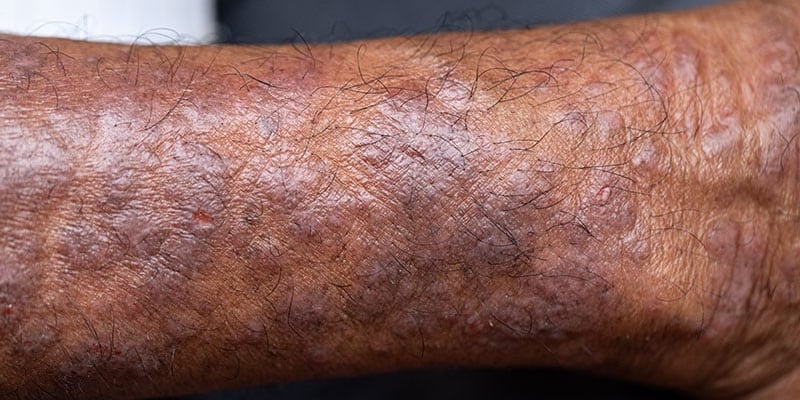 深色皮肤的癌症警报：为何皮肤癌和黑色素瘤在您身上更难发现？