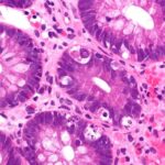 Axatilimab（Niktimvo）治疗慢性移植物抗宿主病：长期疗效与耐受性数据深度解析