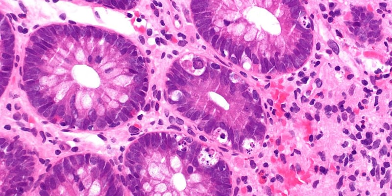 Axatilimab（Niktimvo）治疗慢性移植物抗宿主病：长期疗效与耐受性数据深度解析