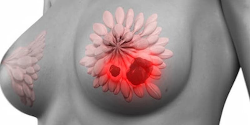 SABCS 2025乳腺癌最新进展：口服SERD、ADC疗效数据与免疫治疗新方案深度解读