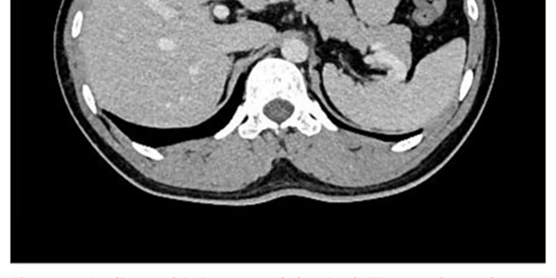 罕见SDH缺陷型GIST治疗新进展：伊马替尼无效？舒尼替尼/瑞戈非尼疗效与海外用药选择