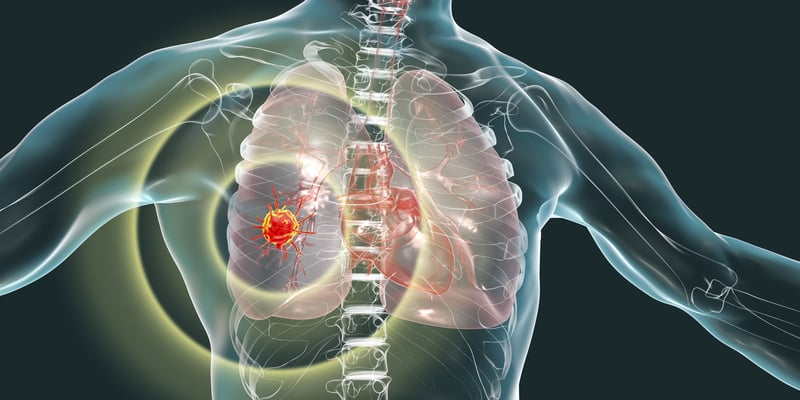 埃万妥单抗联合拉泽替尼显著延长EGFR突变非小细胞肺癌患者总生存期：MARIPOSA研究揭示亚洲人群新希望