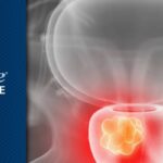 前列腺癌精准治疗：研究证实阿比特龙与恩扎卢胺疗效存在种族差异