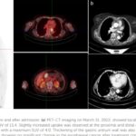 罕见双原发食管癌+胃癌如何治疗？NGS检测与信迪利单抗联合放化疗的成功案例解析
