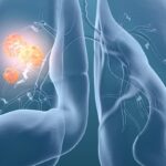 小细胞肺癌新进展：Ociperlimab联合替雷利珠单抗与放化疗改善PFS和ORR