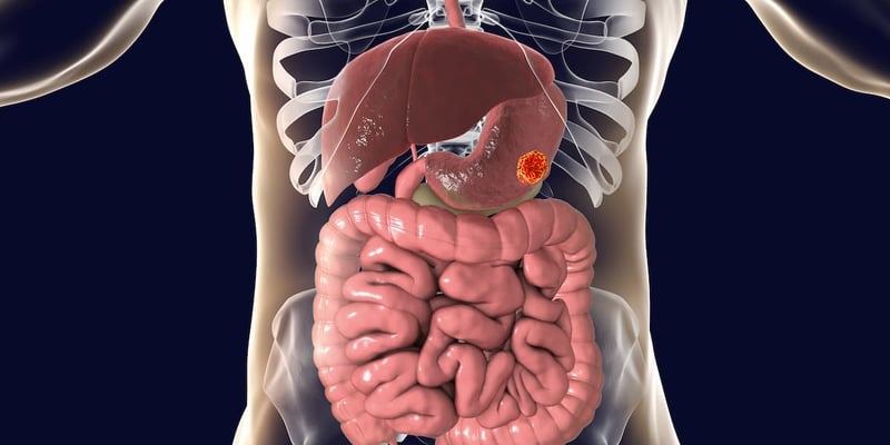卡度尼利单抗一线治疗晚期胃癌：III期数据、疗效优势与海外用药选择