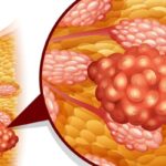 德曲妥珠单抗联合帕妥珠单抗一线治疗HER2+乳腺癌：DESTINY-Breast09最新生活质量数据解读