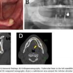 警惕！下巴麻木竟是ALK阳性肺腺癌骨转移信号？阿来替尼治疗8年创生存奇迹