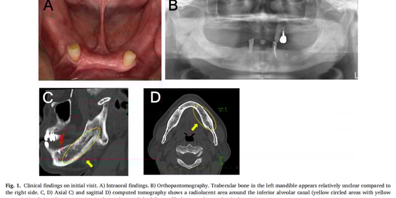 警惕！下巴麻木竟是ALK阳性肺腺癌骨转移信号？阿来替尼治疗8年创生存奇迹