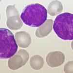 泽布替尼（Zanubrutinib）一线CLL/SLL治疗新突破：6年随访揭示持久疗效与海外获取