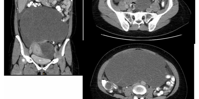 低级别阑尾黏液性肿瘤（LAMN）罕见脾转移：挑战病理认知，ctDNA监测与长期随访新思路