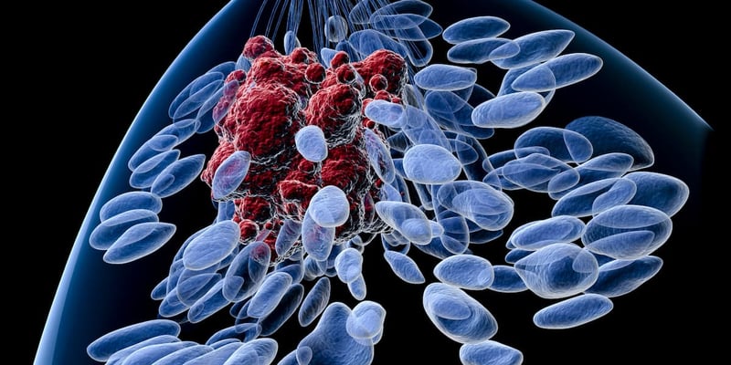 乳腺癌新辅助化疗后，腋窝淋巴结清扫术还能替代吗？最新研究揭示更优选择