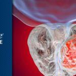 转移性前列腺癌（mCRPC）新方案：Venetoclax联合Enzalutamide的疗效、安全性与购买渠道解析