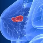 哌柏西利（Palbociclib）辅助治疗乳腺癌：PALLAS试验7年OS数据解读与CDK4/6抑制剂选择指南