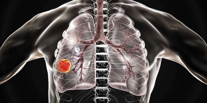 依沃西（Ivonescimab）联合化疗：晚期鳞状非小细胞肺癌患者生活质量与生存期的突破性改善