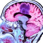 肿瘤电场治疗(TTFields)新篇章：已获批用于胶质母细胞瘤、肺癌和间皮瘤，价格及副作用全解析