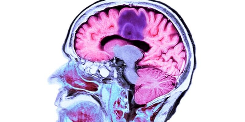 肿瘤电场治疗(TTFields)新篇章：已获批用于胶质母细胞瘤、肺癌和间皮瘤，价格及副作用全解析