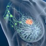 早期乳腺癌术前MRI：最新研究揭示对患者预后无额外益处，诊疗策略再思考