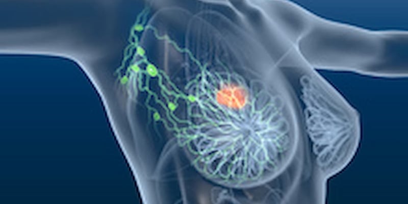 早期乳腺癌术前MRI：最新研究揭示对患者预后无额外益处，诊疗策略再思考