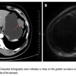 野生型GIST新靶点：FGFR2融合驱动的胃肠道间质瘤如何治疗？伊马替尼疗效与靶向药选择深度解析