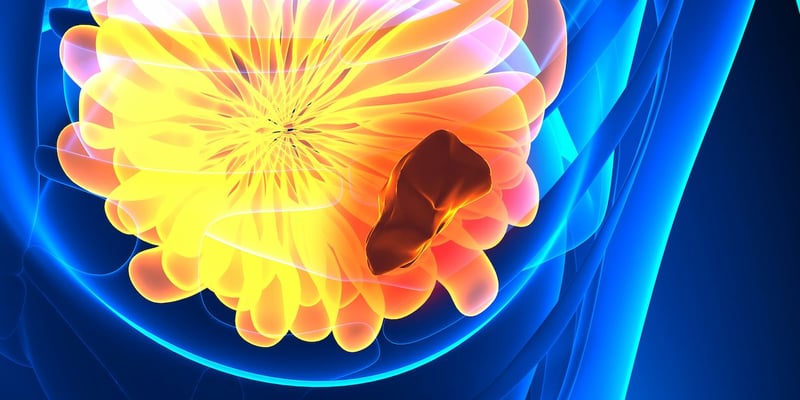 ALTERNATE研究：Anastrozole/Fulvestrant新辅助内分泌治疗如何改变ER阳性乳腺癌手术选择与淋巴结管理？